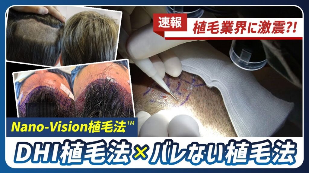 【徹底解説】従来のFUE法を超える？！最新植毛治療で理想の髪型を手に入れる方法